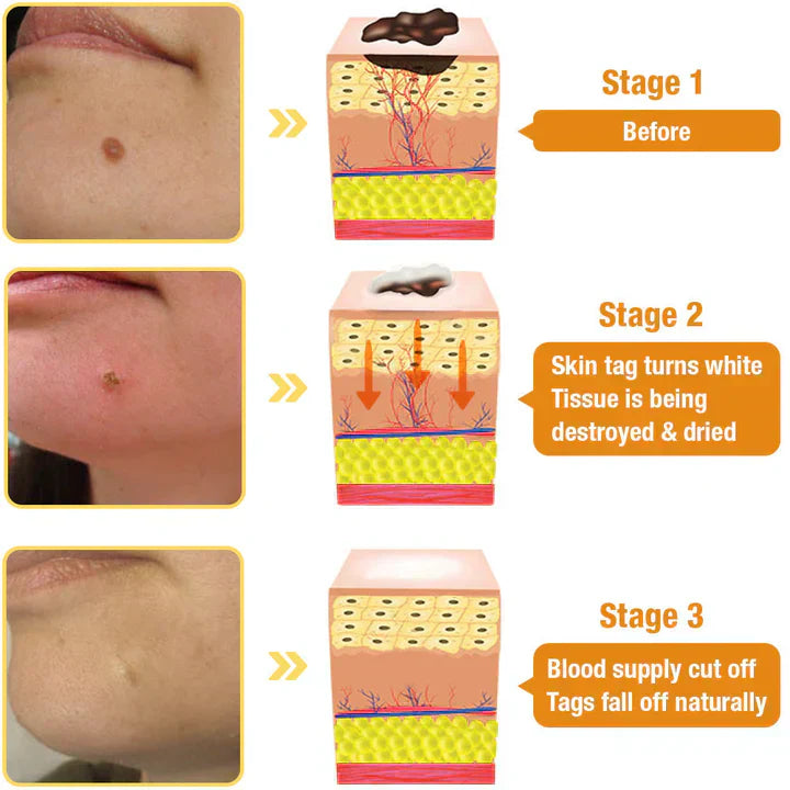 Last Day Of Discount 🔥 TagRecede Bee Venom Treatment Spray